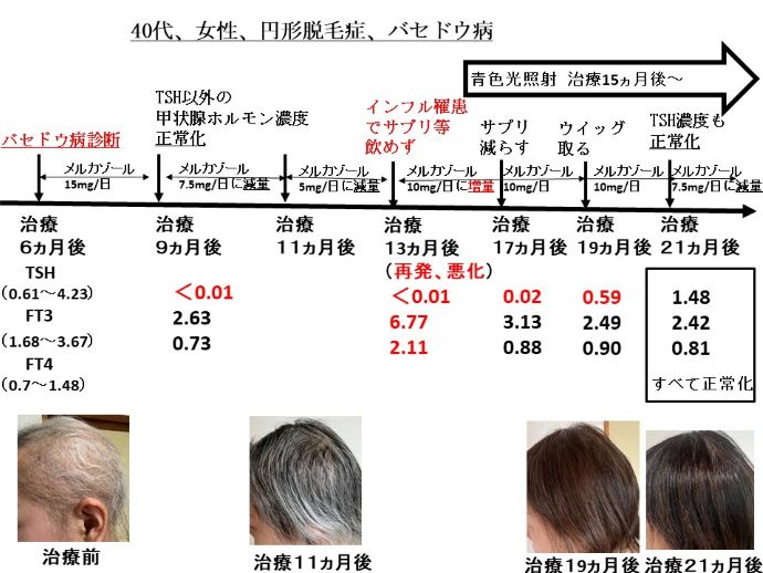 円形脱毛症　病院